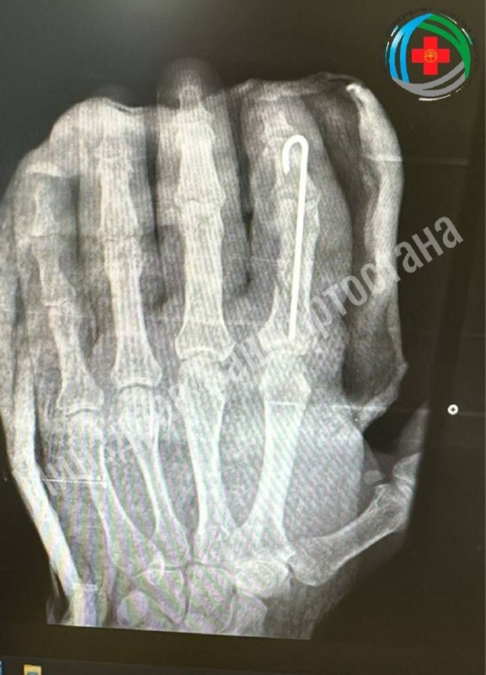 Жителю Башкирии пришили отрубленный топором палец